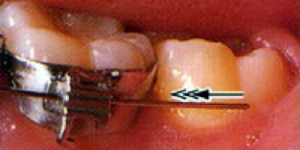 archwire