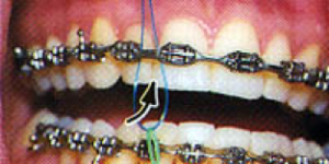 flossing-1