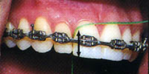 flossing-2