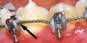 loose-bracket