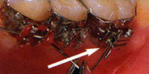poking-wire