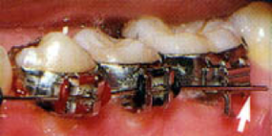wire-out